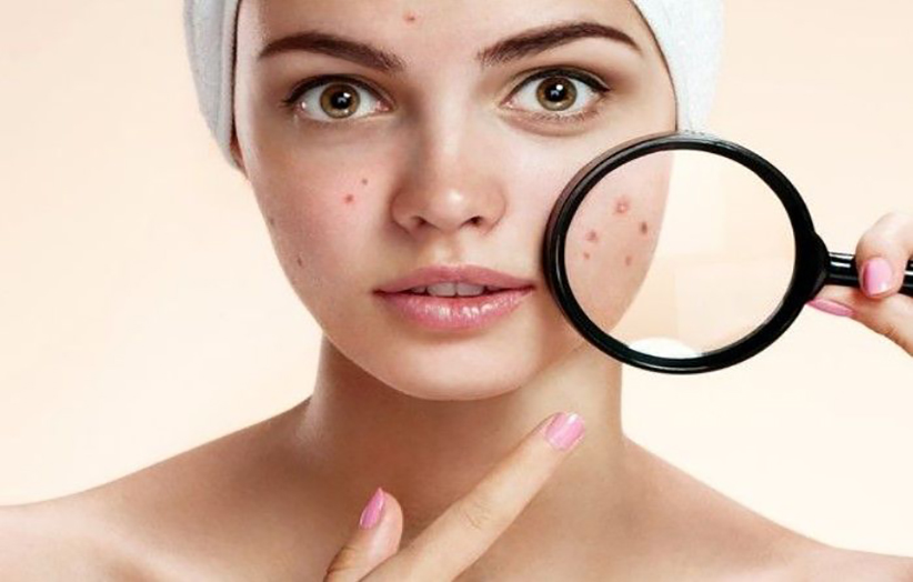 روتین برای پوست جوش‌دار